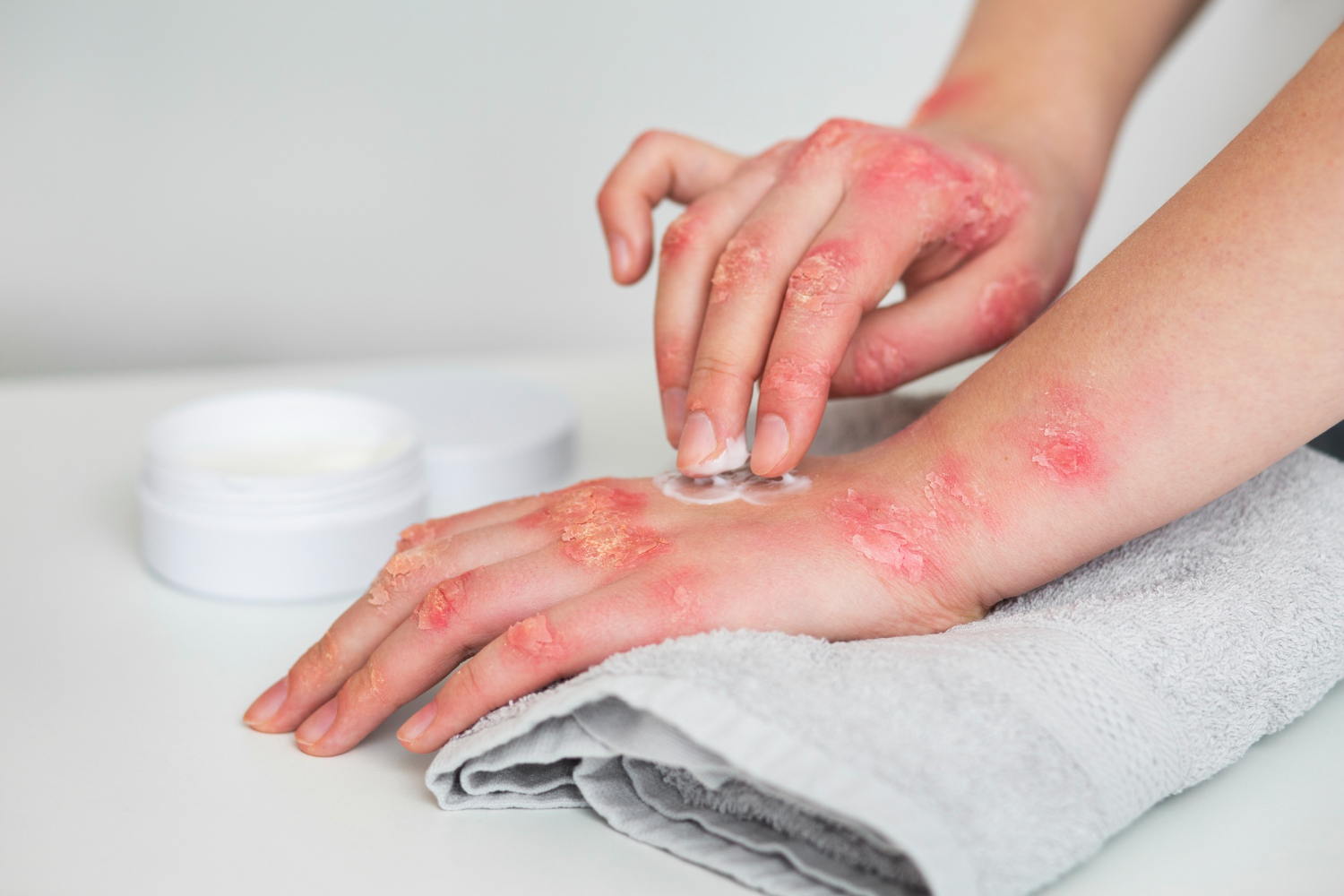 Discover Top Eczema Treatment Centers Near You for Effective Relief