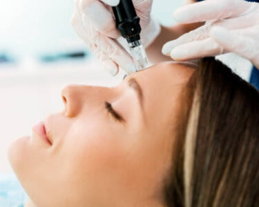 microneedling naples fl