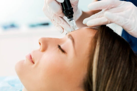 microneedling naples fl