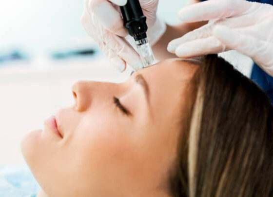 microneedling naples fl