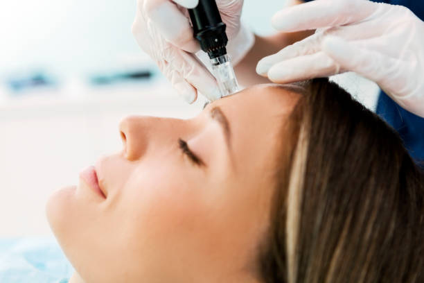 What Does Microneedling in Naples, FL Do for Your Skin?